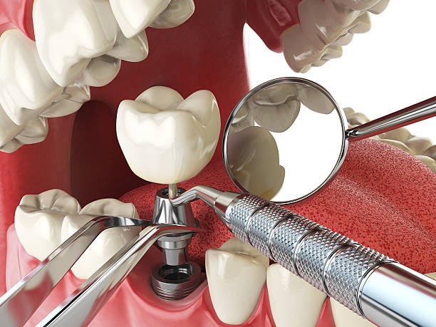 Best Emergency Denture Repair in Hallowell, ME